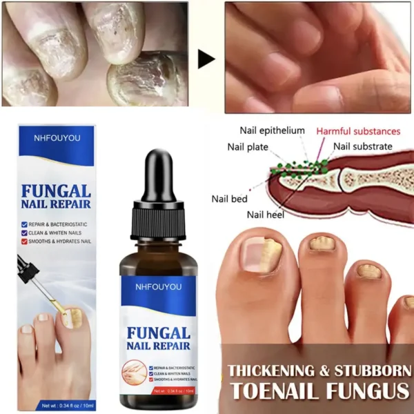 Laser irradiation nail fungus nail repair solution is used for discolored, thickened and fragmented nails. Laser irradiation pen - Image 2