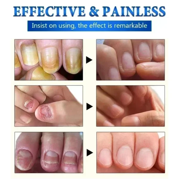 Toenail Nail Fungus Treatment Repair Fingernail Device Toenail Treatment for Foot Nail Fungus Essential Oil Onychomycosis Care - Image 3