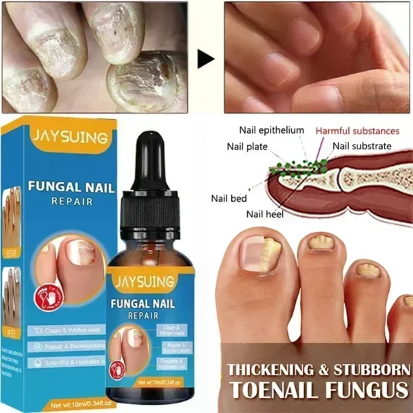 Toenail Nail Fungus Treatment Repair Fingernail Device Toenail Treatment for Foot Nail Fungus Essential Oil Onychomycosis Care