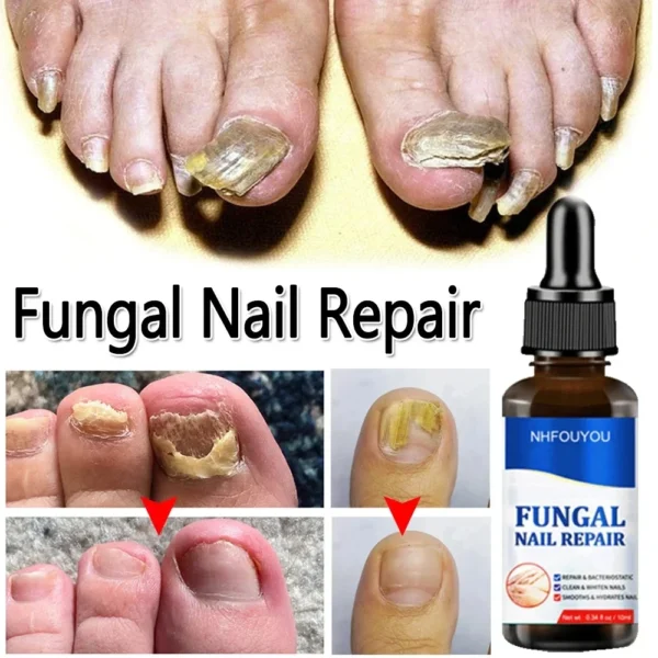 Laser irradiation nail fungus nail repair solution is used for discolored, thickened and fragmented nails. Laser irradiation pen - Image 5