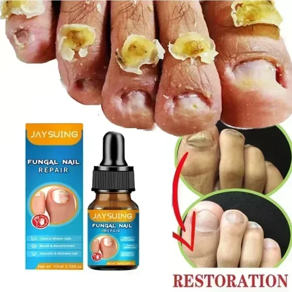Toenail Nail Fungus Treatment Repair Fingernail Device Toenail Treatment for Foot Nail Fungus Essential Oil Onychomycosis Care - Image 6