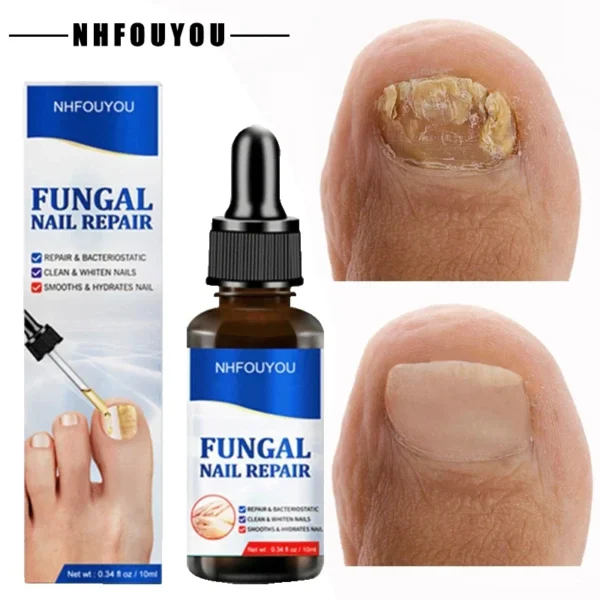 Laser irradiation nail fungus nail repair solution is used for discolored, thickened and fragmented nails. Laser irradiation pen - Image 6