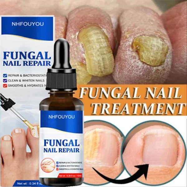 Laser irradiation nail fungus nail repair solution is used for discolored, thickened and fragmented nails. Laser irradiation pen - Image 3