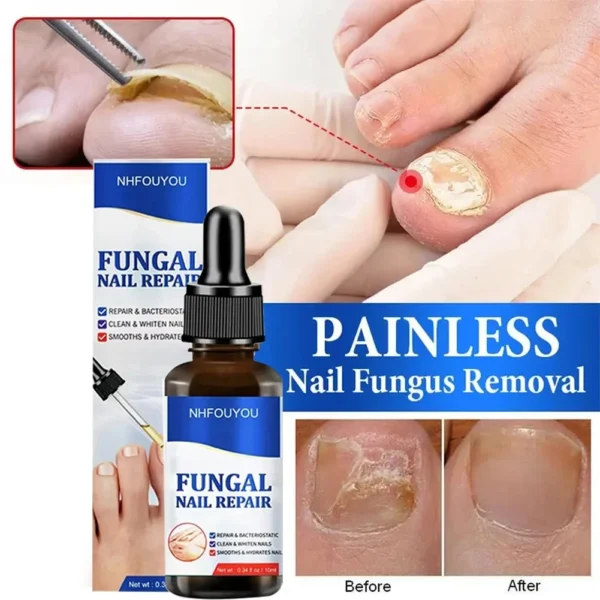 Laser irradiation nail fungus nail repair solution is used for discolored, thickened and fragmented nails. Laser irradiation pen - Image 4